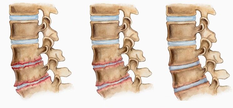 La deformación de los discos intervertebrales en la osteocondrosis puede causar dolor de espalda