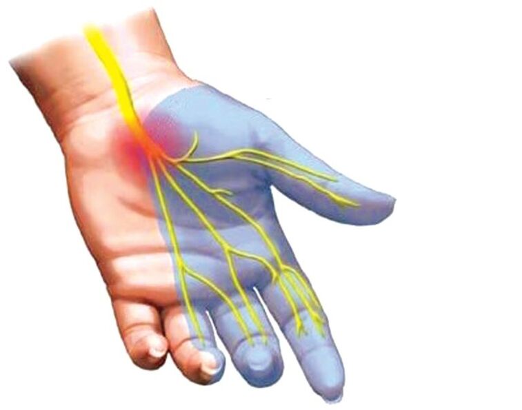 entumecimiento de la mano con osteocondrosis