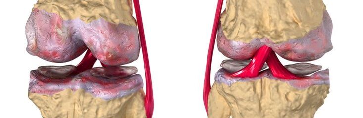 Articulación sana y artrosis de la articulación de la rodilla