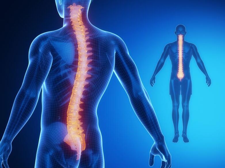 Osteocondrosis de la columna, que requiere un tratamiento complejo.