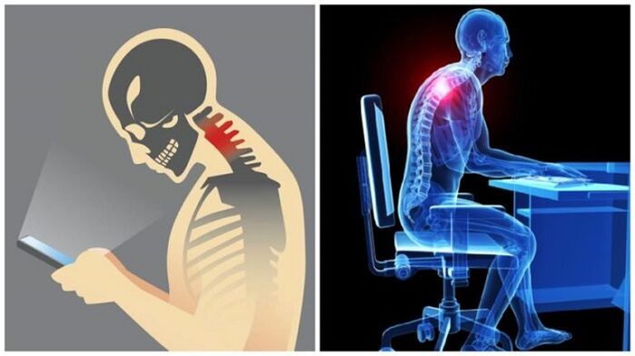 Trabajo sedentario y encorvamiento como las razones del desarrollo de la osteocondrosis. 