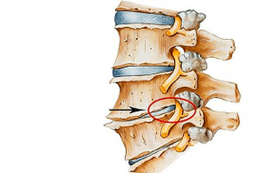 disco pinzado de la columna vertebral como causa de osteocondrosis cervical