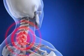 dolor en el cuello con osteocondrosis
