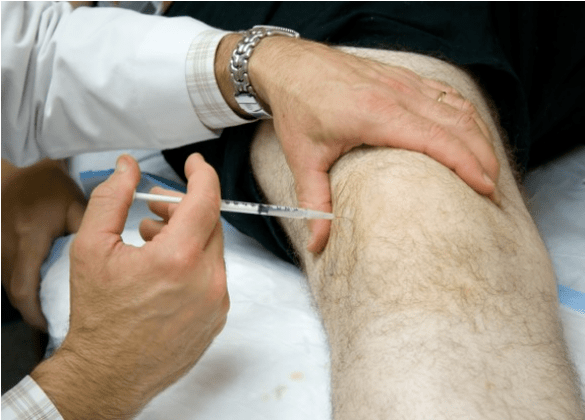 Administración intraarticular de analgésicos en dolor severo