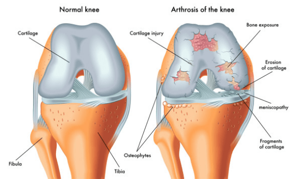 Articulación normal y afectada por la artrosis